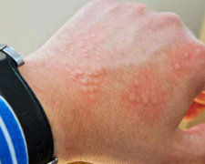 Що таке Холодова алергія? Криворізький дитячий лікар пояснює (КОРИСНО)