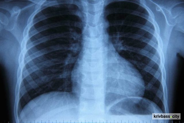 Понад 3 тисячі мешканців Дніпропетровщини з туберкульозом і підозрою отримали безоплатну медичну допомогу